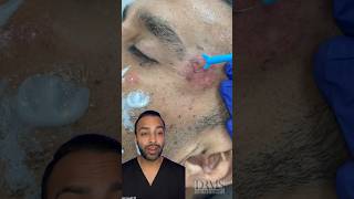 Removing Seborrhoeic Keratoses | Dr Somji