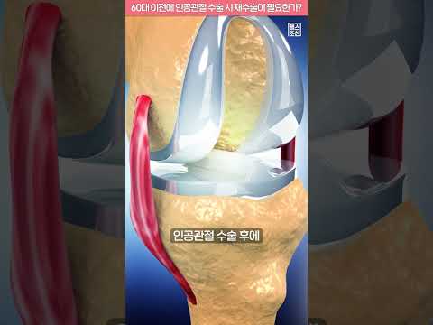 60대 이전에 인공관절 수술 시 재수술이 필요한가? #shorts