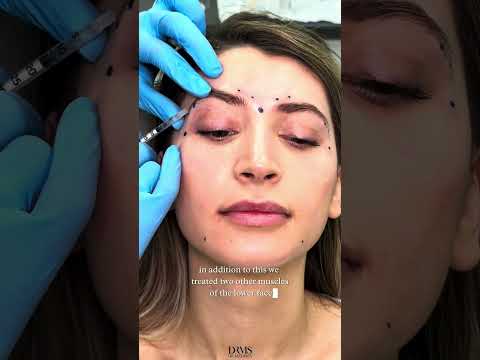 Brow Lift Botox - No Risk of Drooping! - DrMedispa