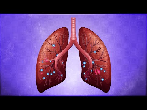 Severe viral lung infections and ARDS, causes and effects