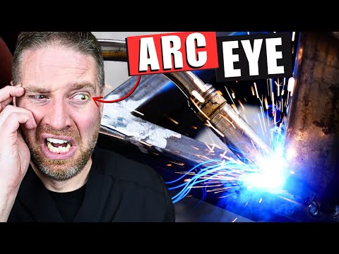 What Really Happens To A "WELDER'S FLASH" EYE BURN! (Best Remedies)