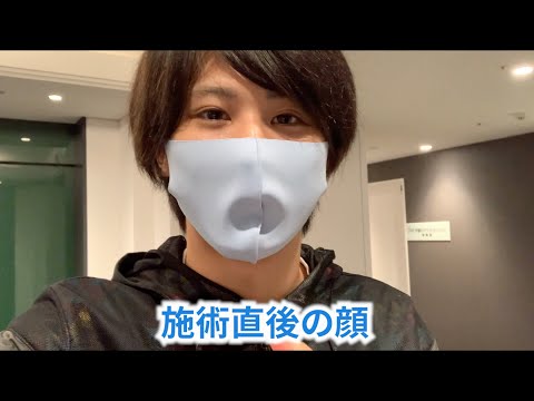 【照射17回目】ヒゲ脱毛直後の顔面を公開します【医療レーザー脱毛】