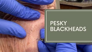 Pesky Blackheads | Dr. Derm