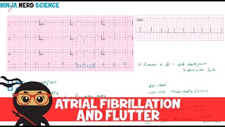 Rate and Rhythm | Atrial Fibrillation and Atrial Flutter