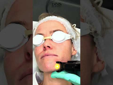 Pigmentation & Rosacea Be Gone! Harmony XL PRO Laser Results - DrMedispa