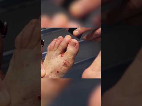 SHOCKING BUNION CORRECTION! #bunion #bunions #feet #foot