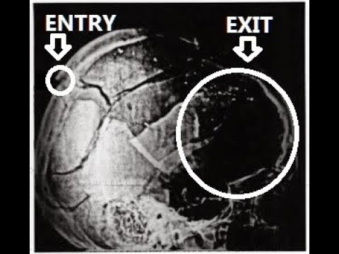 JFK FILE RELEASE LATEST !! NEW X RAY !!!!!! BOMBSHELL !!!!!