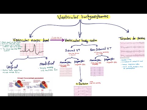 VEB, V.tachycardia, V.fibrillation, Torsade de pointes (part 1)