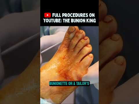 Full bunion removal videos! #bunion #bunions #feet #foot