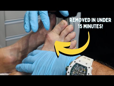 Arthritic Bump Removed in Under 15 Minutes