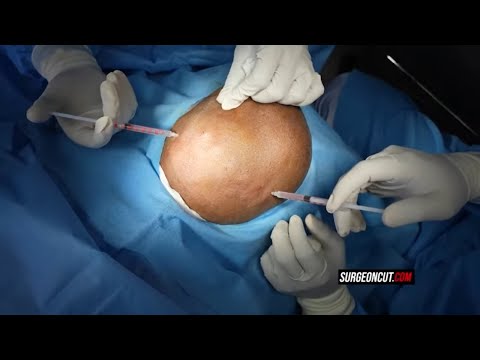 Hair Transplant Surgery | Before & After