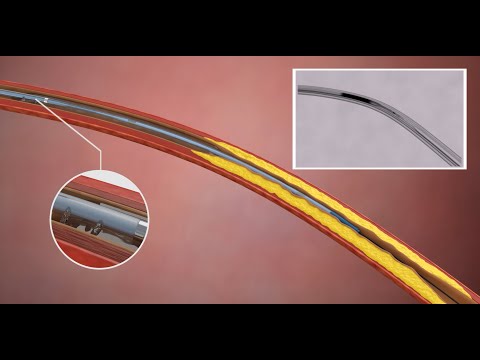 Finesse BTK catheter for peripheral arterial surgeries - 3D animation