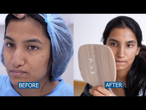 Reconstructive Rhinoplasty Surgery | Before & After Results