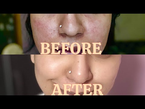 How I restored my damaged skin barrier in 4 days with just 4 products | Simple and Easy