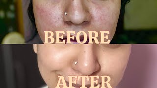 How I restored my damaged skin barrier in 4 days with just 4 products | Simple and Easy