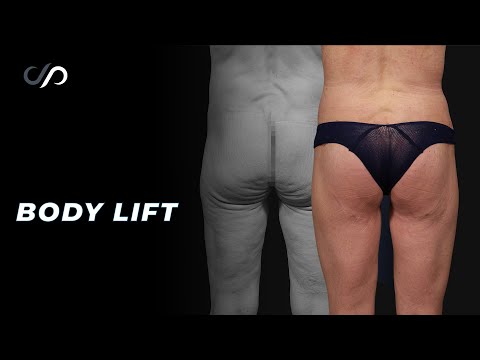 Lower Body Lift Surgery | 10-Day Post op Result