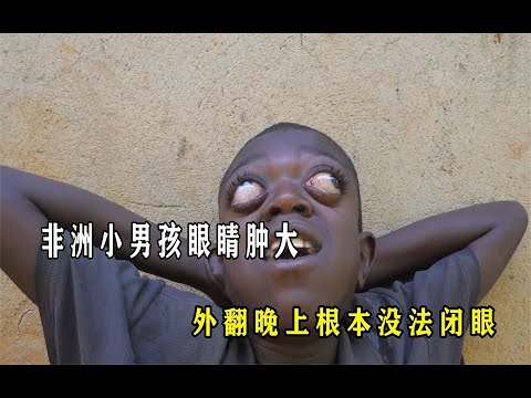 男孩眼睛外翻像石头，整天在用泪水洗脸，晚上睡觉根本合不上眼