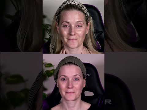 My 12 weeks before and after using the NEWA+ device #beforeandafter #skincaredevice #doctoranne