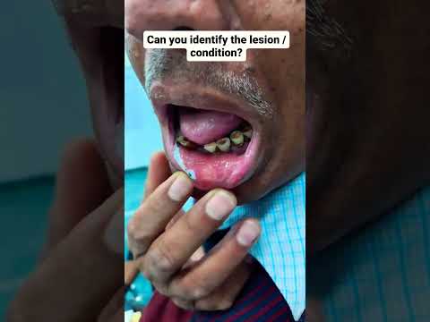 Can you identify the lesion / condition? #mouthcancer #oralcancerawareness #oralhealth #dentalcare