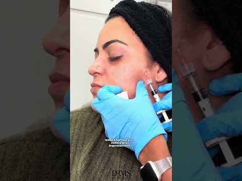 How Profhilo Works: Injection Points in Action with Dr.Zahra - DrMedispa