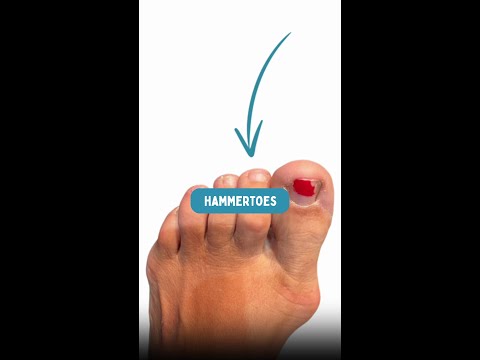 What is a hammertoe? #hammertoe #podiatrist