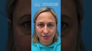 Eyelid Surgery: The Healing Process