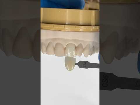 Single Hollywood Ceramic Veneer #lsk121shorts #dentist #teeth