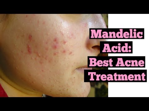 Mandelic Acid Best Treatment for Acne | What is Mandelic Acid? | Clear Skin Tips