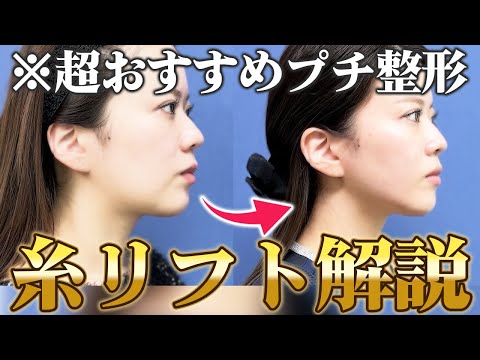 【糸リフト解説】美肌効果もアリ✨小顔になれる糸リフトについて解説します！