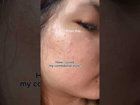 Get rid of acne permanently| acne treatment| skincare routine 💕😍🌸✨ #shorts #viral #beauty #short