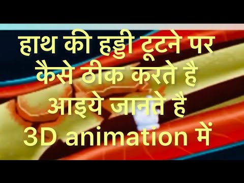 Hand bone Repair in 3D animation! हाथ की हड्डी को कैसे ठीक करते है#radiusbone#viral #3danimation