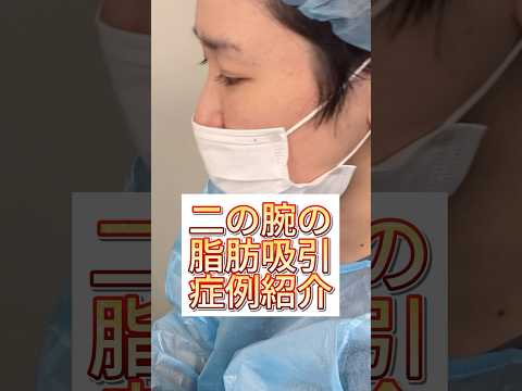 二の腕と肩を脂肪吸引して一回り細い腕にしてみた！