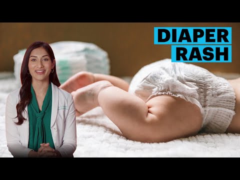 Diaper Rash Symptoms and Remedies | The Parents Guide | Parents