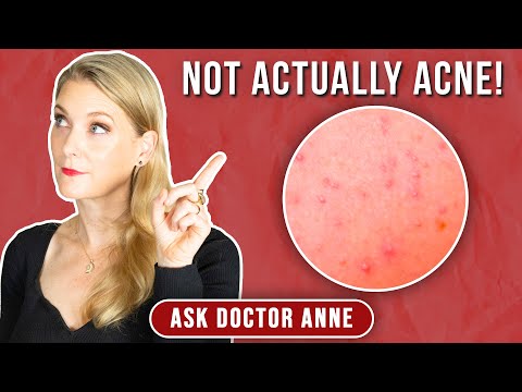 Fungal Acne: Treatment and Prevention Tips for Clear Skin | Doctor Anne