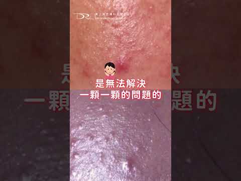 皮膚顆粒感總是治不好？背後原因你可能沒想到！ #痘痘 #皮膚粗糙 #蠕形蟎蟲 #皮膚暗沉 #油性肌膚 #克林達黴素 #杜鵑花酸 #過氧化苯