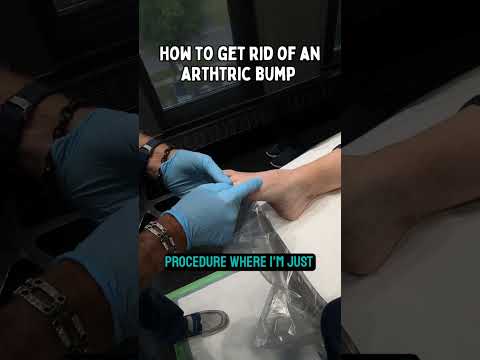 HOW TO GET RID OF AN ARTHRITIC BUMP 🤯