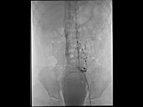 Thrombolytic therapy for Massive Venous Thrombi – Video S1 [478213]