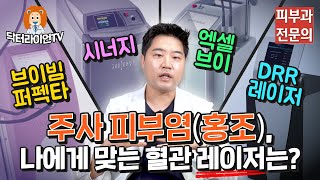 주사피부염 및 안면 홍조에 가장 효과적인 혈관 레이저는? 레이저 장단점 비교! (브이빔/시너지/엑셀브이/DDR레이저)