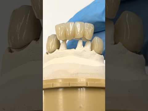 Incisor Bridge between Keyway Attachment Canines #lsk121shorts #dentist #teeth