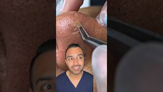 OMG I was not expecting that blackhead extraction on the nose! Dr Somji reacts