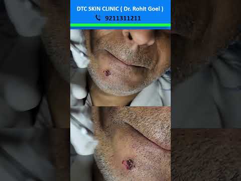 Wart Removal Treatment | Dr. Rohit Goel