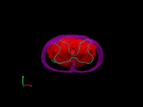 Translational Project Video Spinal Lesion 3D Reconstruction