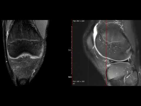 lateral meniscus anterior horn tear