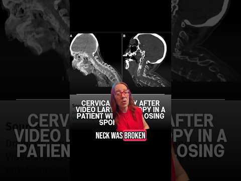 This is truly unbelievable. 🥺 #ankylosingspondylitis #spine #healthcare #neck