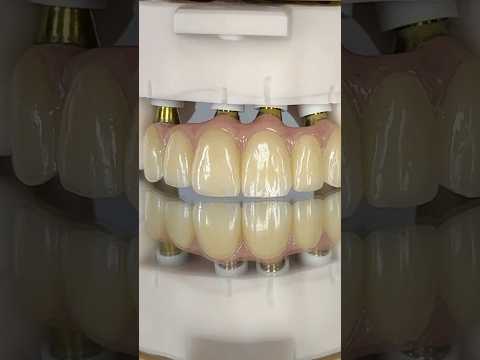 Amazing Anterior Zirconia Arch Implants #lsk121shorts #dentist #teeth