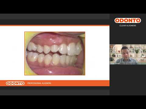 DAY 3 ODONTO Aligners Webinar Series