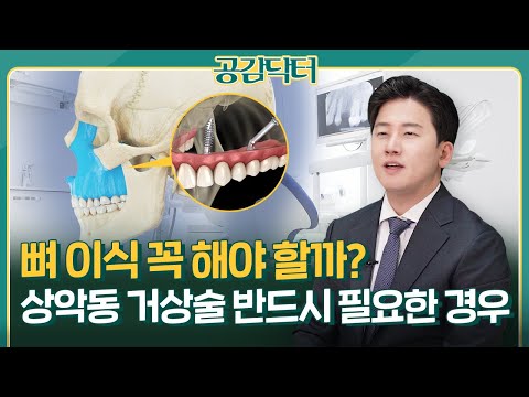 상악동 거상술 반드시 필요한 경우는? 임플란트 수명 늘리는 방법 [공감닥터]