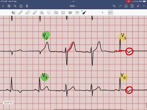 CASE_4 inferolateral NSTEMI