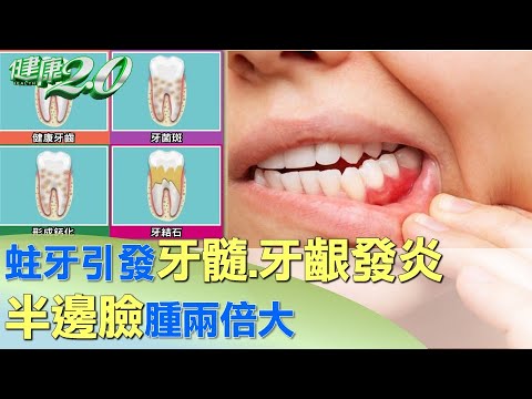 婆婆蛀牙引發牙髓.牙齦發炎 半邊臉腫兩倍大 健康2.0 @tvbshealth20