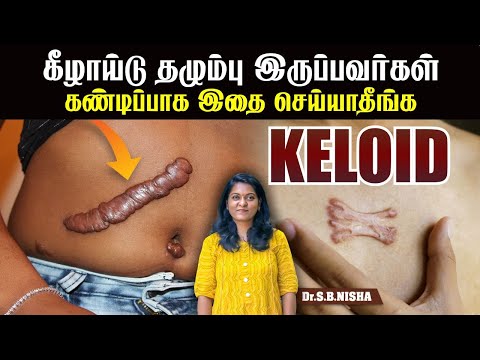 கீழாய்டு தழும்புக்கு செய்யக் கூடாதவைகள்  | avoid keloid patients |Dr.S.B.Nisha| MADURAI HOMEOPATHY